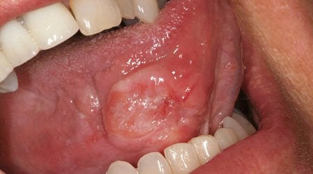 Enfermedades de Mucosa Oral y Genital