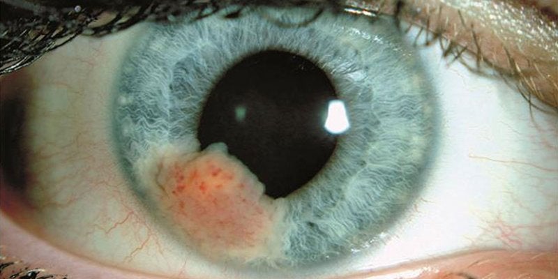 Tumores Oculares