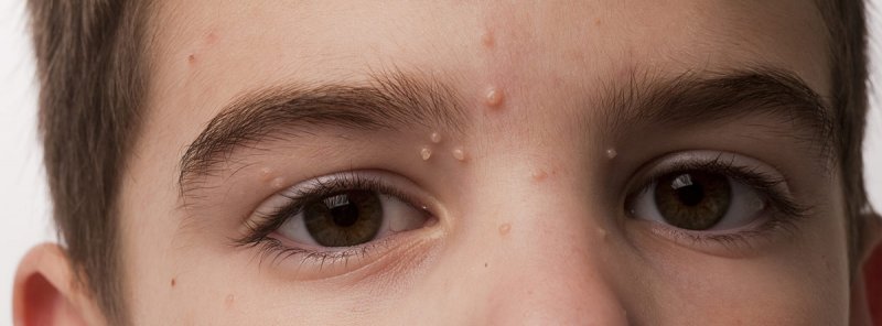 molusco-contagioso