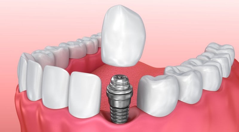 implantes-dentales