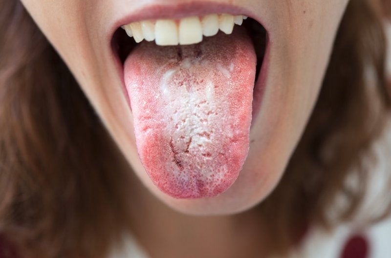 Enfermedades de lengua más comunes