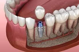 Implantes Dentales