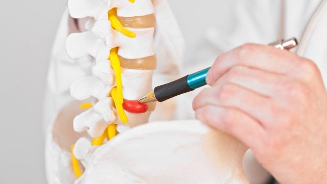 ¿Cómo tratar la hernia discal?