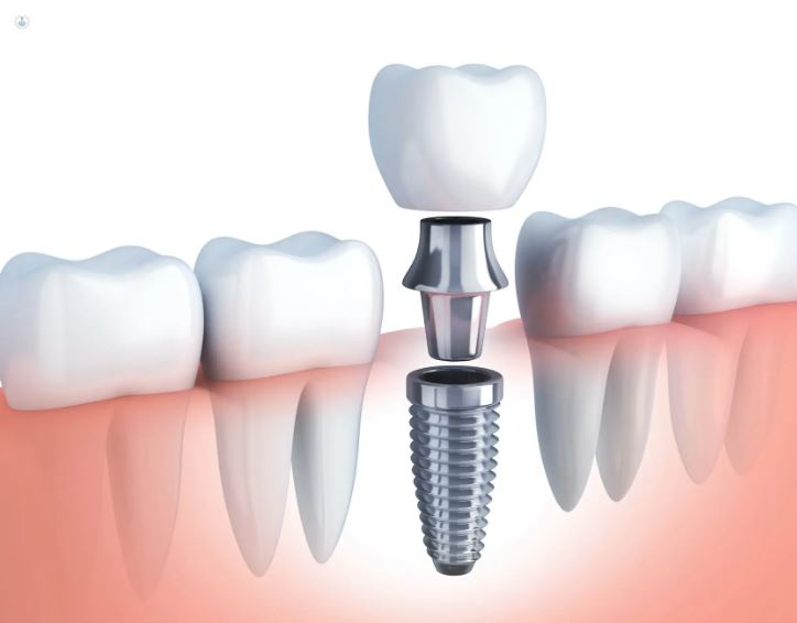 IMPLANTES DENTALES