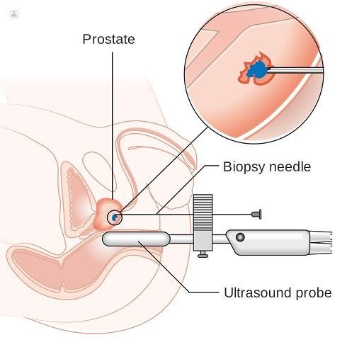 examen de prostata