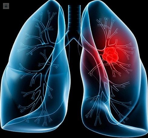 sintomas de cancer de pulmon