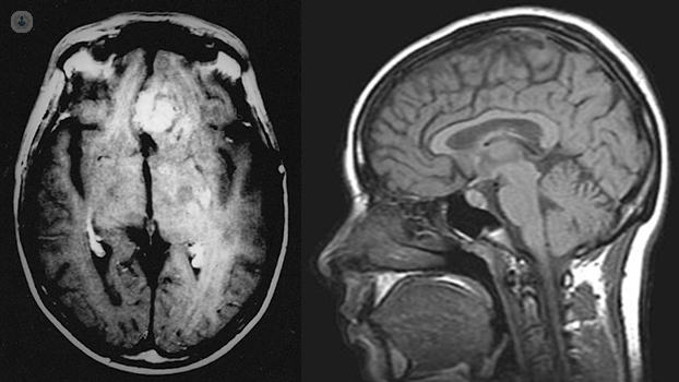 Tumor cerebral