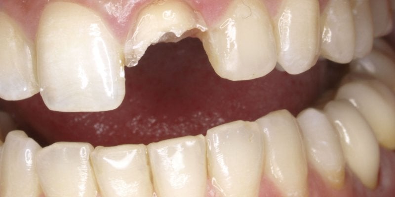 ¿Qué es una fractura de diente?
