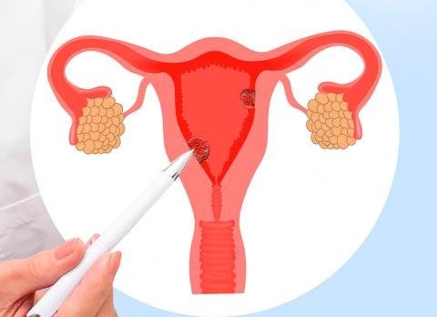 Pólipo endometrial