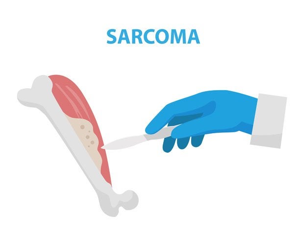  Sarcoma en tejidos blandos