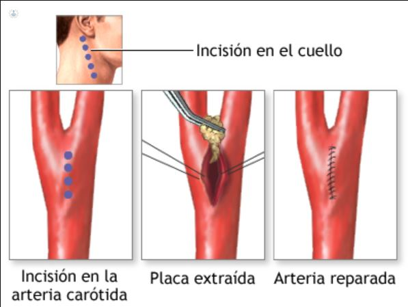 Cirugía de la Arteria Carótida