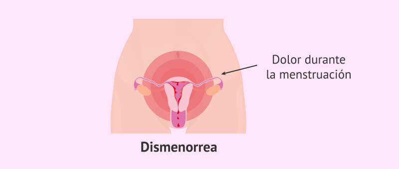 Dismeorrea