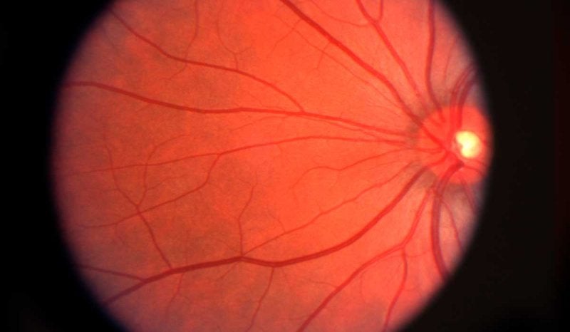 retinopatía-diabética