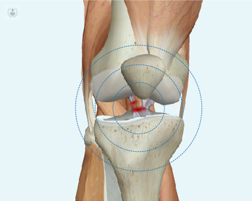 ligamentoplastia