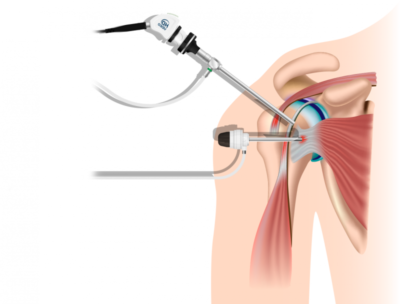 Artroscopia de Hombro
