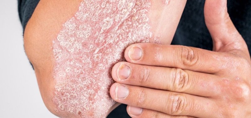 Psoriasis