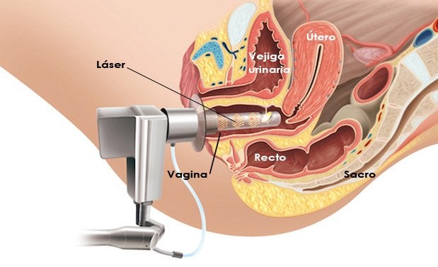 Laserterapia en Ginecología