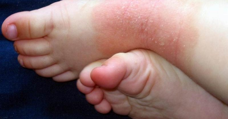 Dermatitis Atópica en Niños