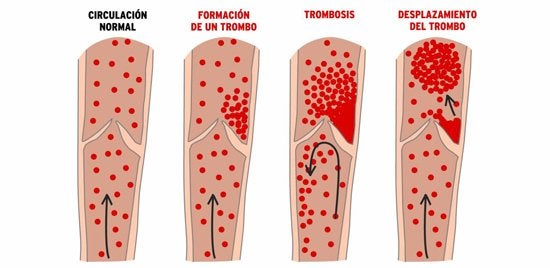 Trombosis y Embolia