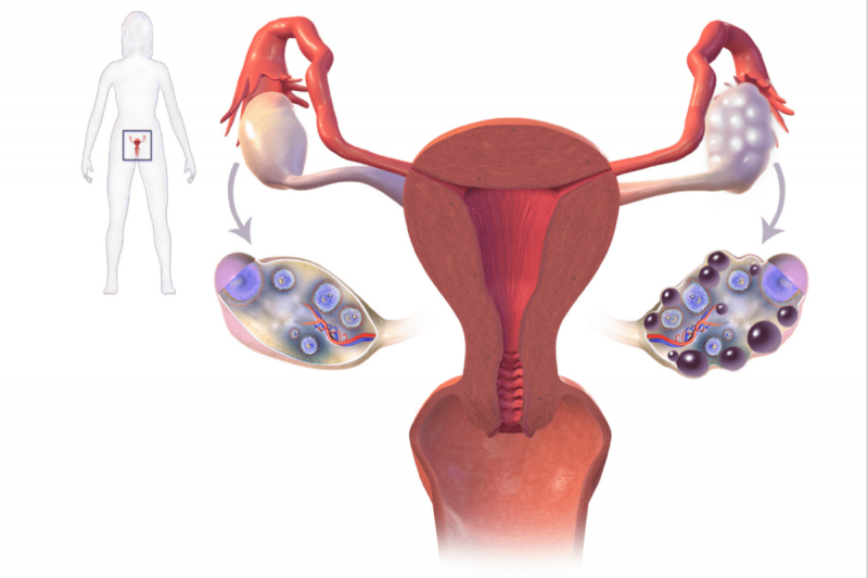 Síndrome de Ovario Poliquístico