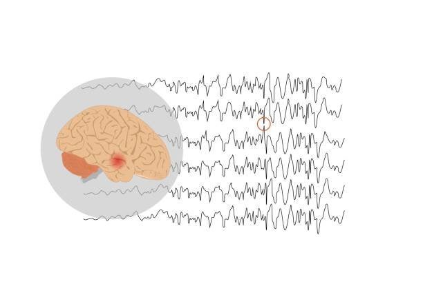 epilepsia del lóbulo temporal