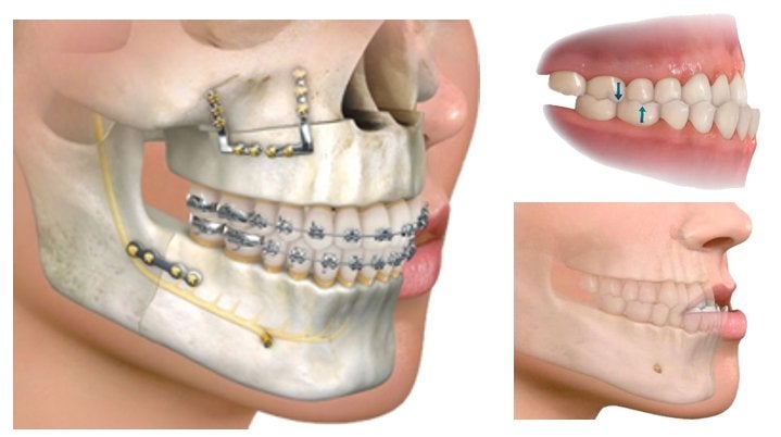 Ortodoncia y Cirugia Ortognatica