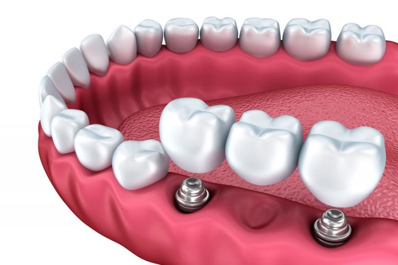 Prótesis dental fija: todos los tipos que existen