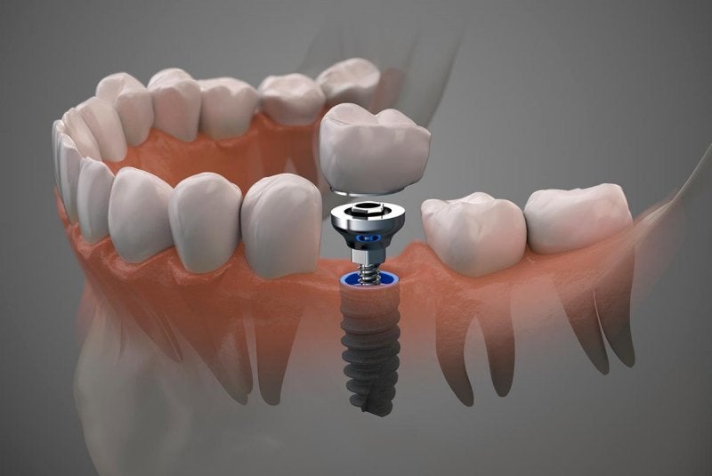 Implantes Dentales