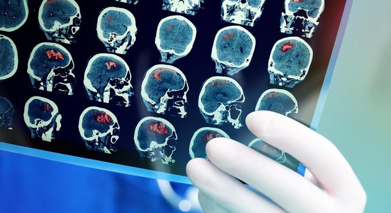 Neurologia Oncologica 