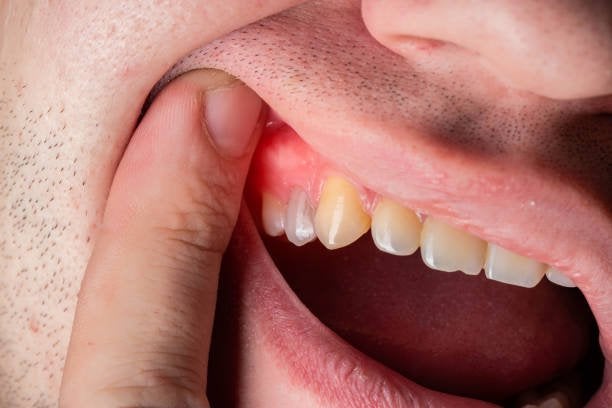 Necrosis Dental