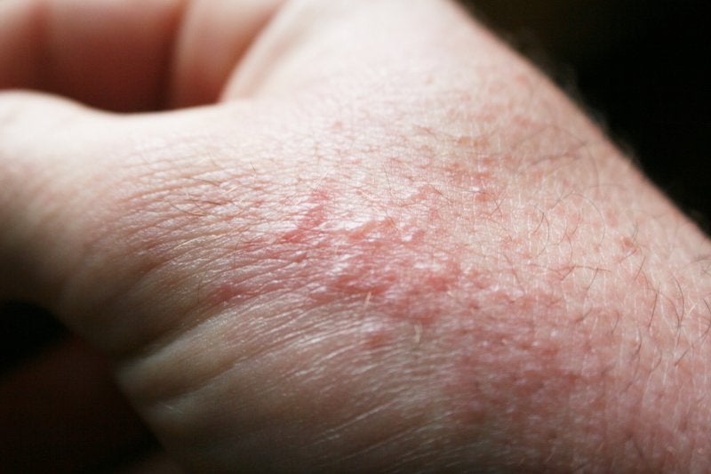 allergic-rash-dermatitis-skin-royalty-free-stock-photography