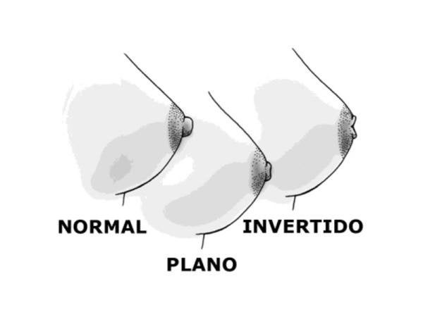 Pezones Invertidos