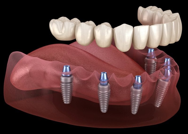 Implantes de Carga Inmediata