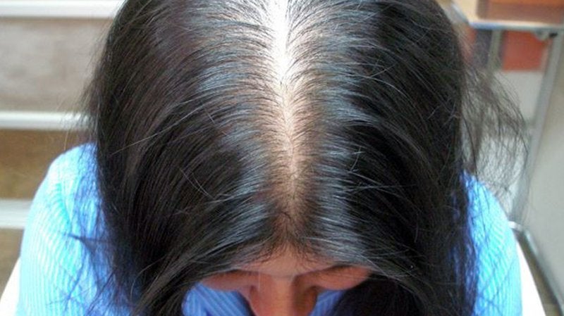 Alopecia diagnóstico