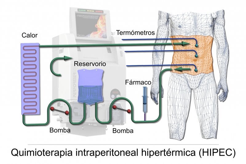 Quimioterapia Intraperitoneal Hipertérmica (HIPEC)