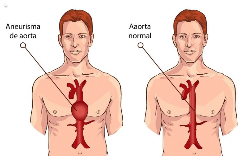 Aneurisma de Aorta