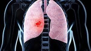 ¿Qué es un nódulo pulmonar?