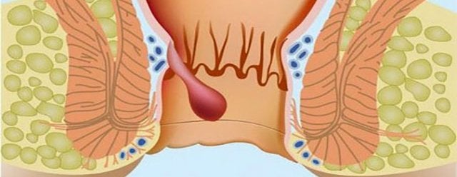 Patologías anales en pacientes homosexuales