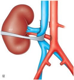 cirugía de la arteria renal