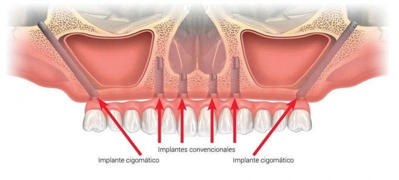  Implantes Cigomáticos