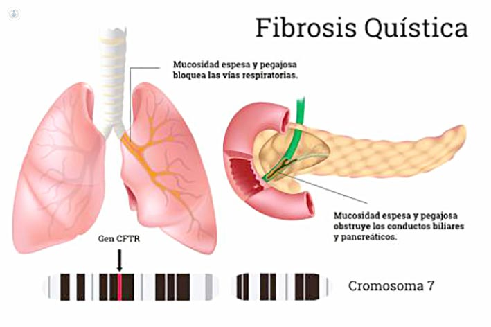 Fibrosis Quística