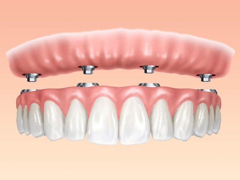 Implantes Dentales