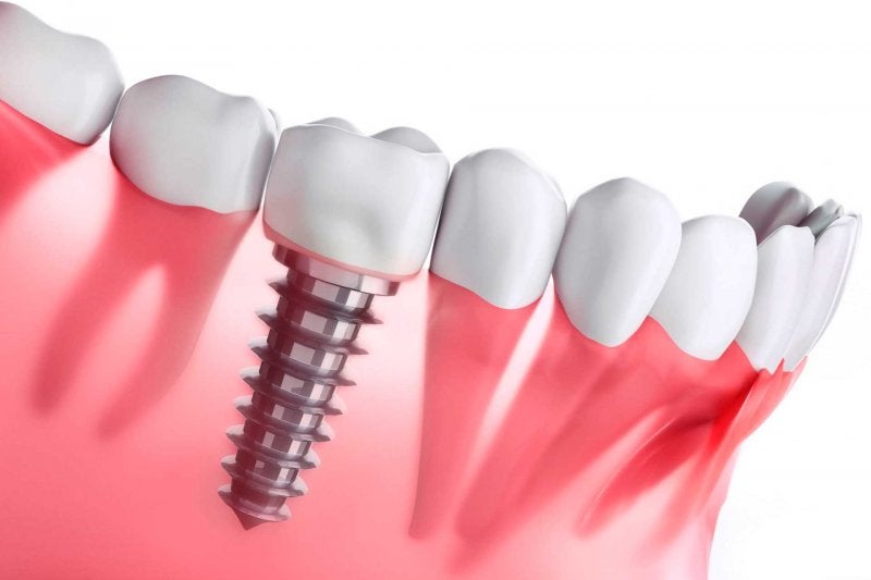 Implantes Dentales