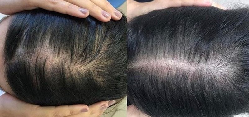 Alopecia Androgenética Femenina