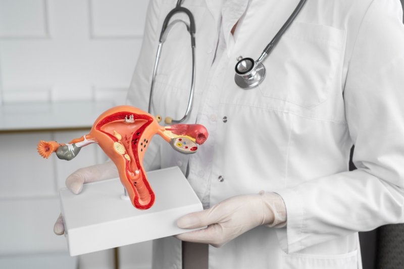 miomatosis uterina