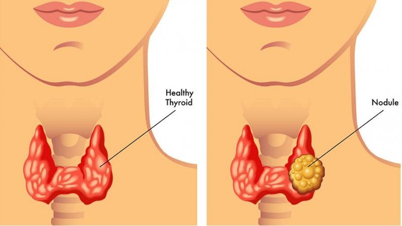 NÓDULO TIROIDEO