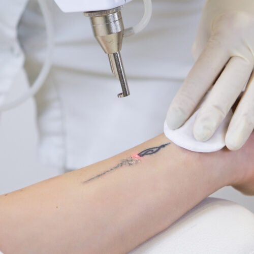 Tratamiento tatuajes con láser