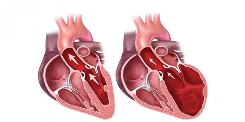 Miocardiopatía Hipertrófica