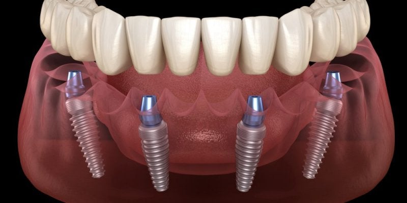 All on Four Implantes Dentales
