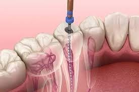 Endodoncia